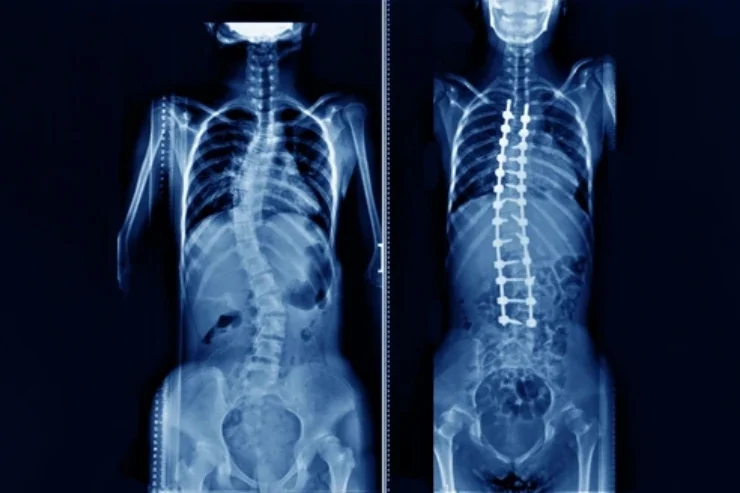 Complex Deformity Correction Surgery-----------12