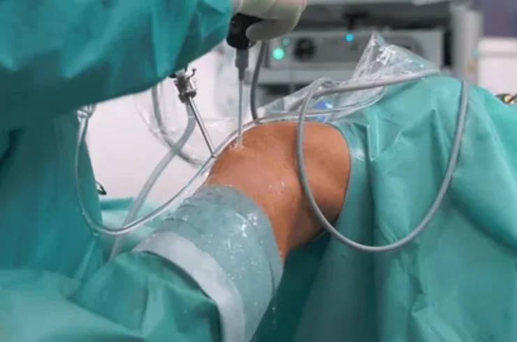 Knee Arthroscopy Surgery