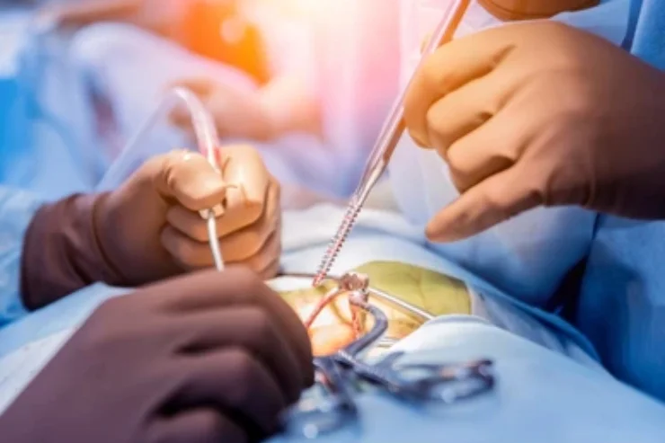 Revision Spine surgery------------12