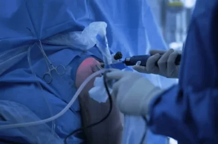 Shoulder Arthroscopy Surgery----------12