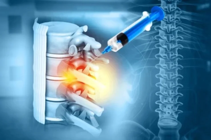 Spinal Injections------------12