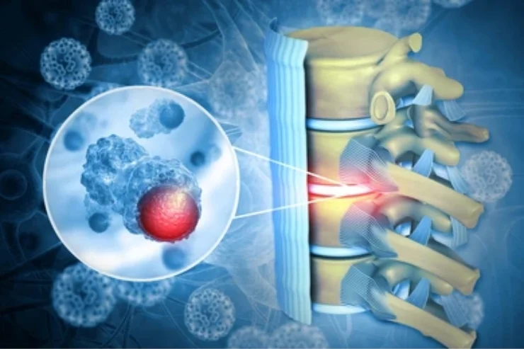 Spinal Tumors-----------12